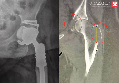 عانت من ورم سرطاني بعظمة الفخذ 