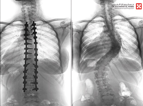 بزاوية «63» و «45» درجة 