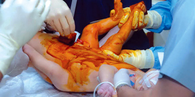 المملكة حريصة على حماية حقوق التوائم الملتصقة وضمان اندماجهم المجتمعي 