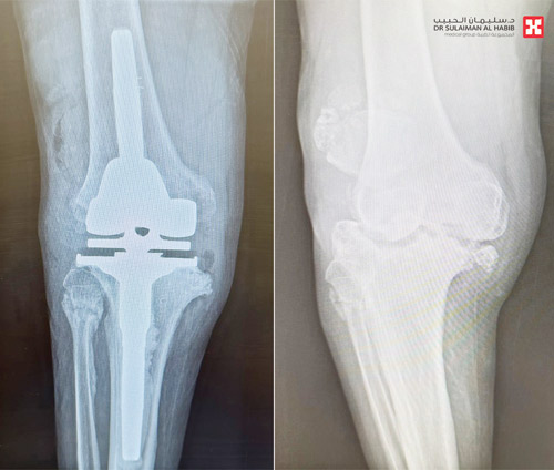 بعملية استبدال مفصل ركبة نوعية ناجحة 