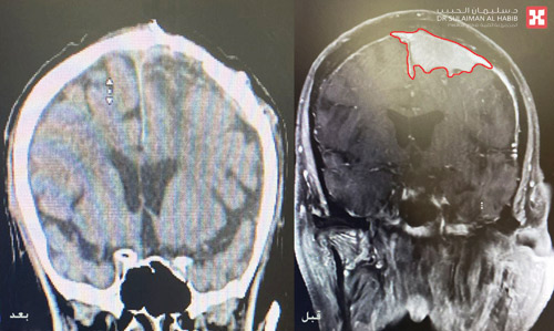 سبَّب له صداعاً مزمناً وتشنجات حادة 