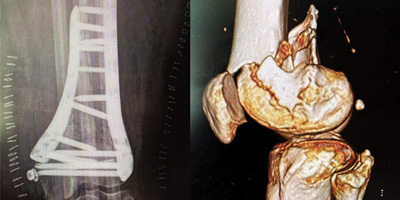 مستشفى الدكتور سليمان الحبيب بالخرج يجري جراحة معقدة لإصلاح كسور تفتتية 