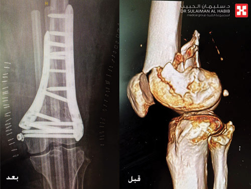 في عظم مفصل الركبة لسيدة ستينية 