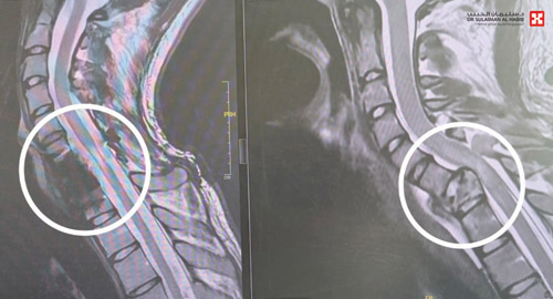 أجرى له عمليتين معقدتين عقب حادث مروري مروع 