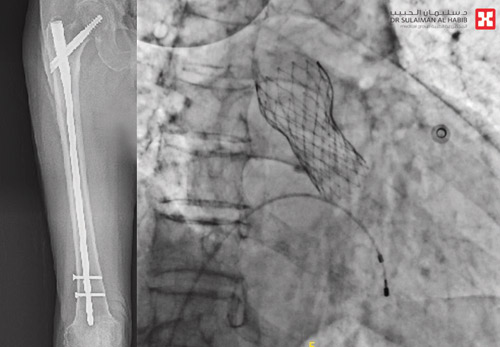 حضر لمعالجة كسر في الحوض 