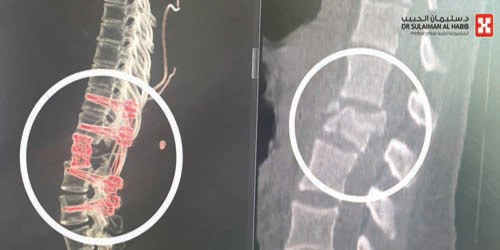 مصابة بكسور معقدة بالعمود الفقري 