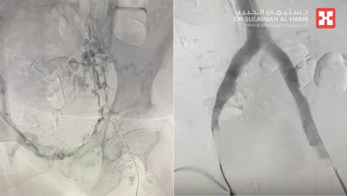 تحت التخدير الموضعي وباستخدام الأشعة التداخلية 